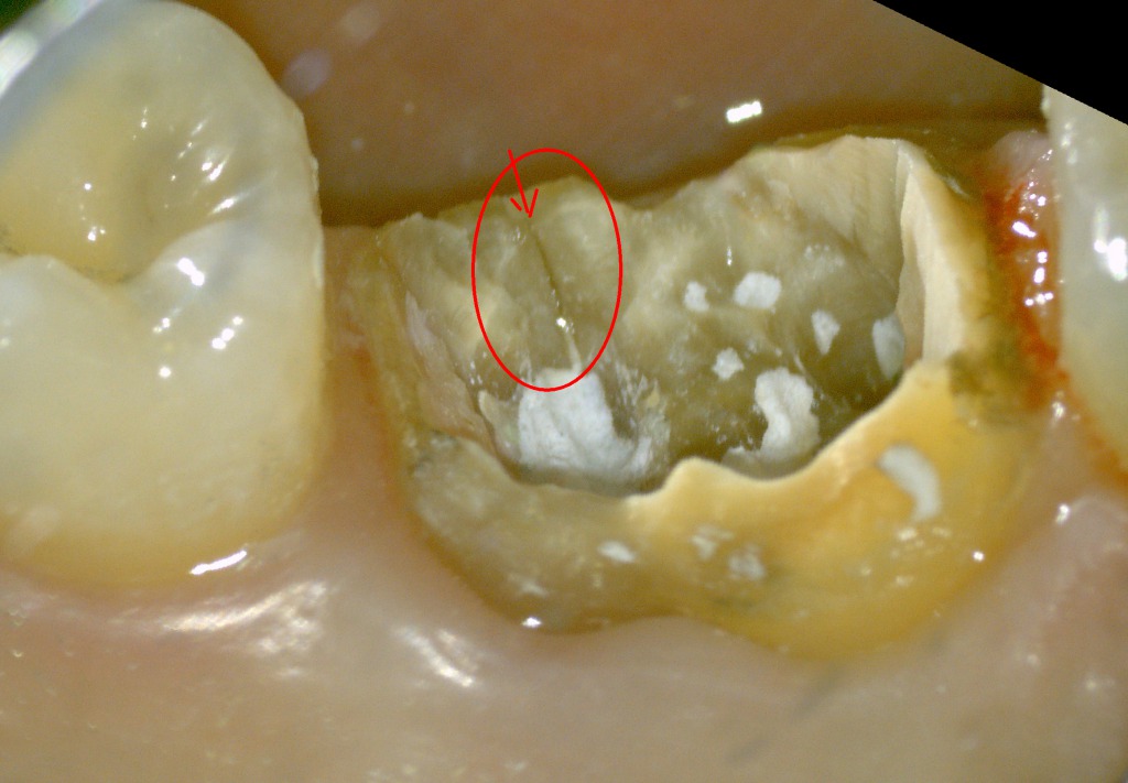 歯根破折の写真１