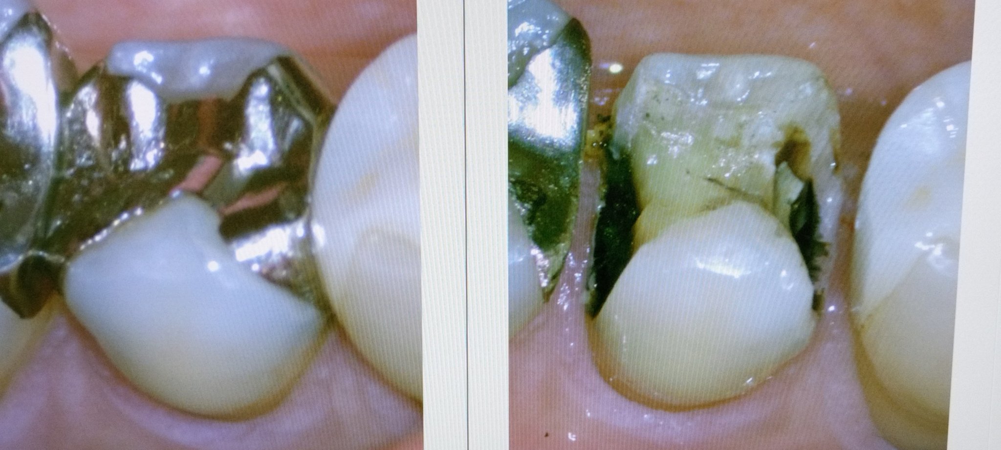 銀歯の再治療