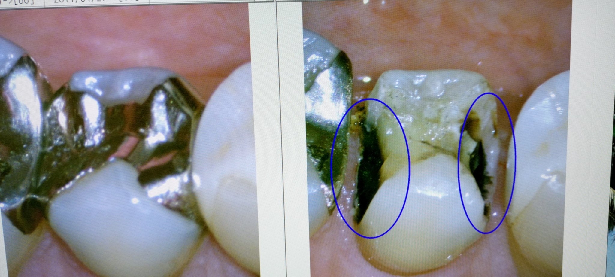 Q. 何故保険治療の銀歯は、虫歯ができるのですか？