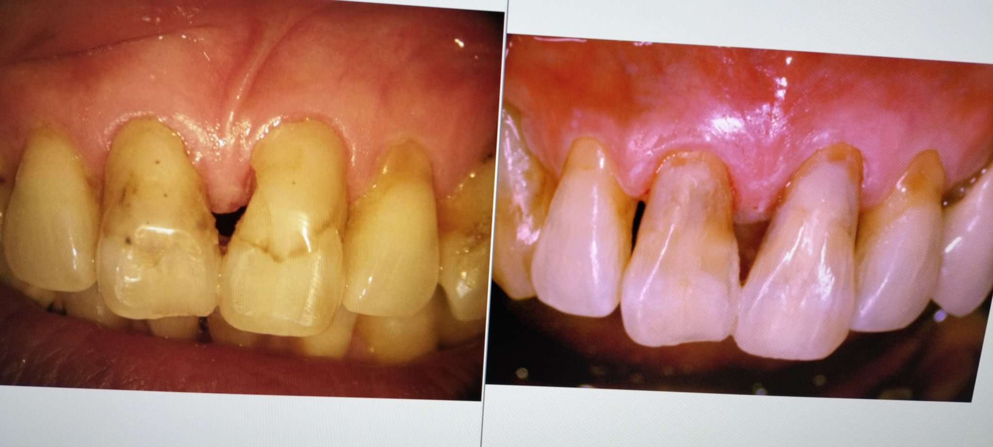前歯の虫歯の治療例