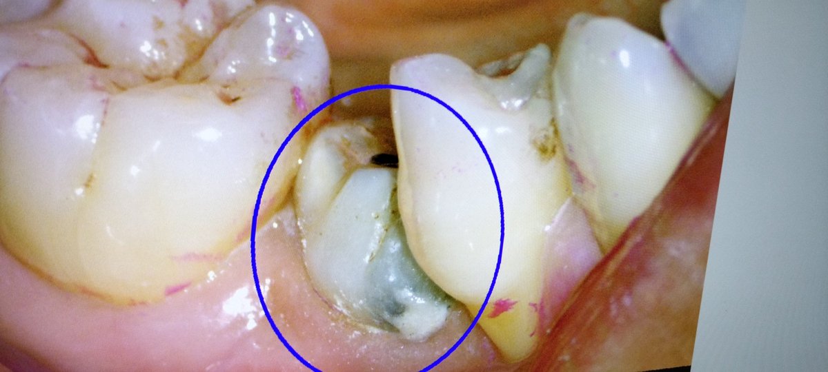 永久歯が先天欠損の場合