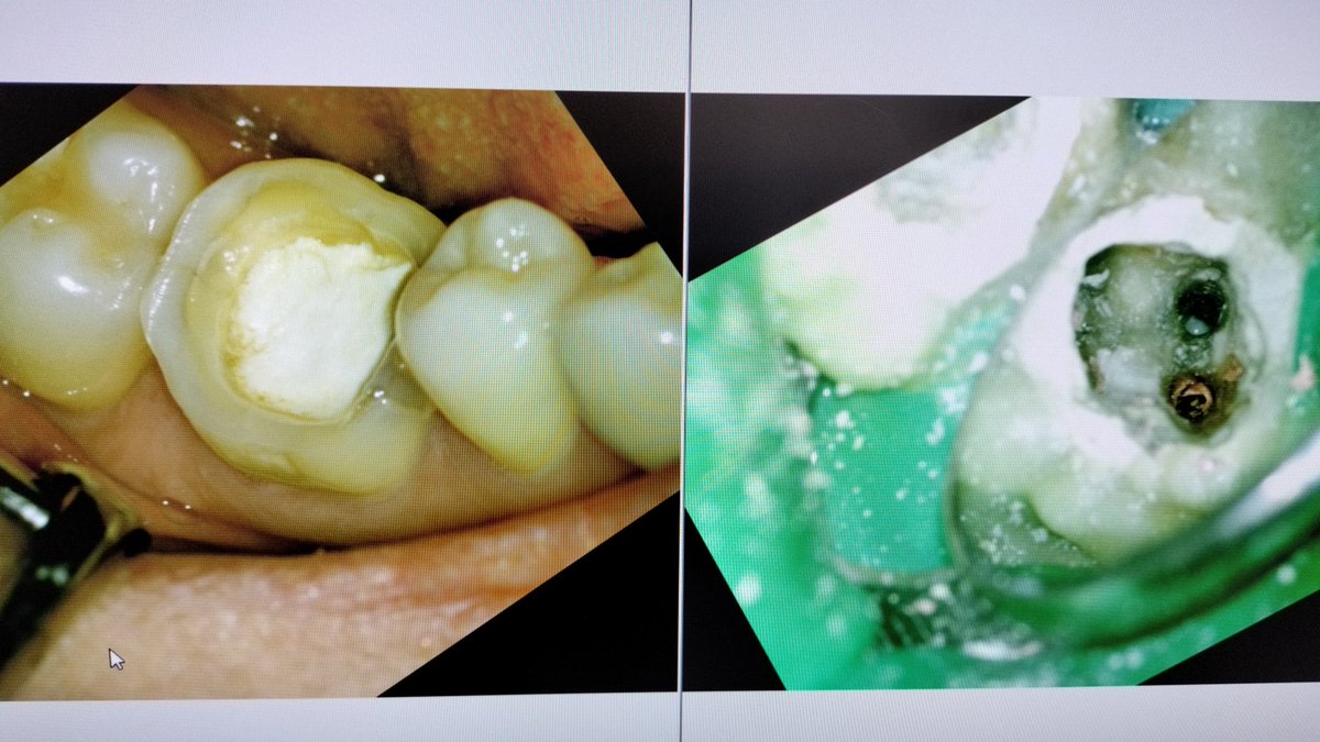 他院で起きた歯の神経を取る治療の症例