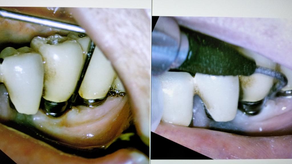 青木歯科ではインプラント周囲炎の治療を行なってます