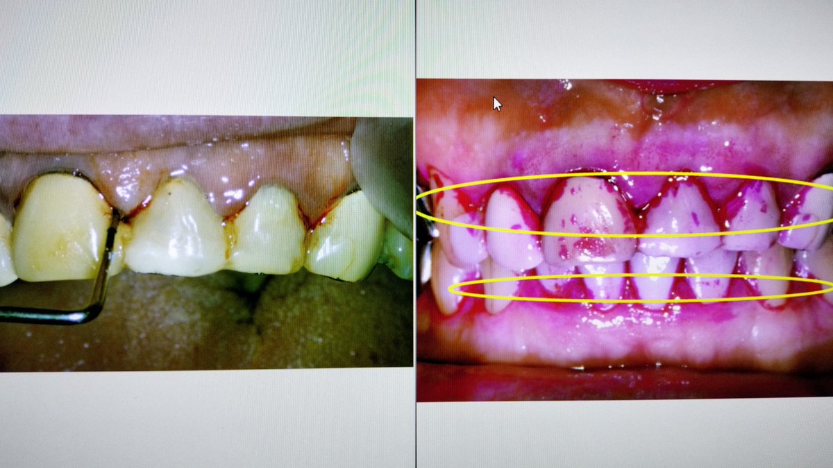 歯周病治療の第1段階