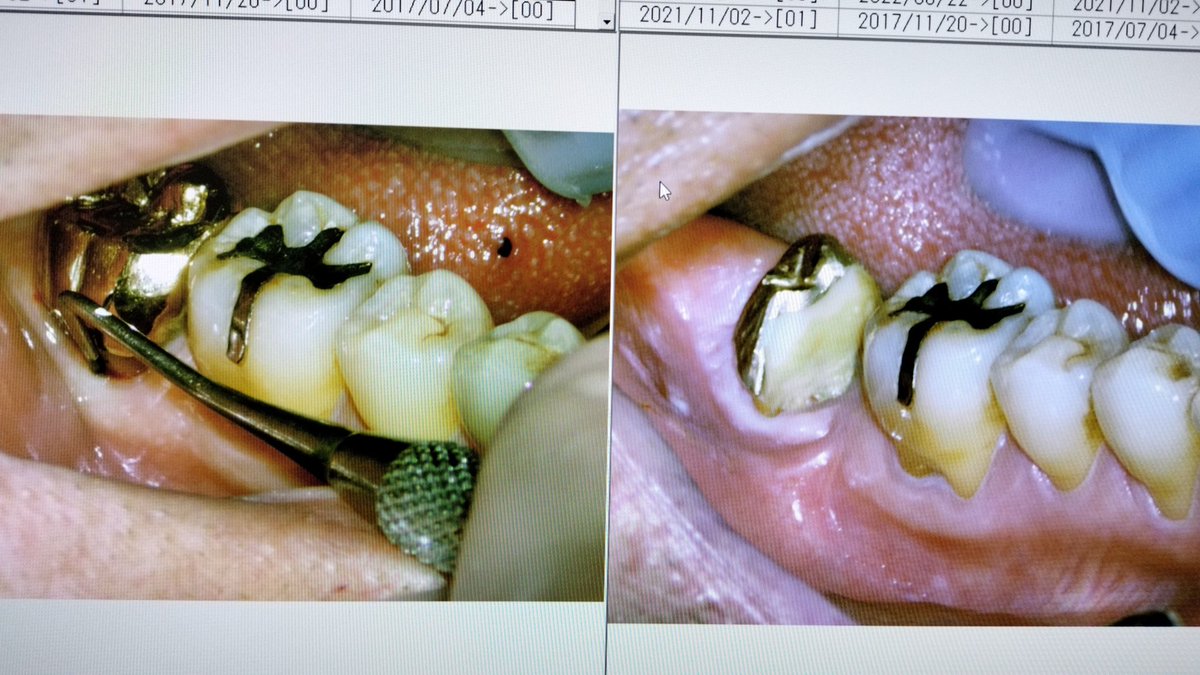 歯根破折の青木歯科での治療例