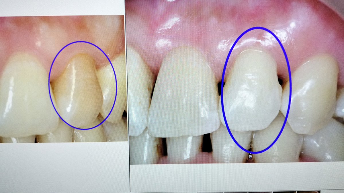 青木歯科での変色歯治療例