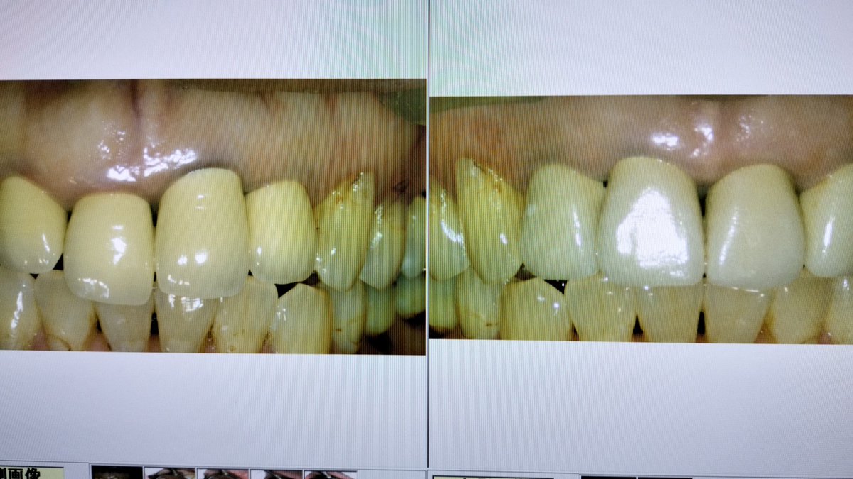 青木歯科での前歯の再治療