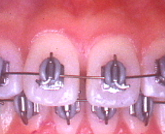 青木歯科のSAS矯正の写真