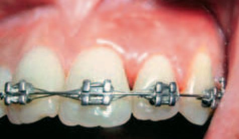 従来法（エッジワイズ法）の写真